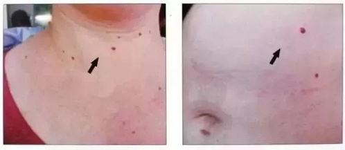 脸上长痣可以吃茭瓜吗,健康饮食与美丽肌肤的完美结合